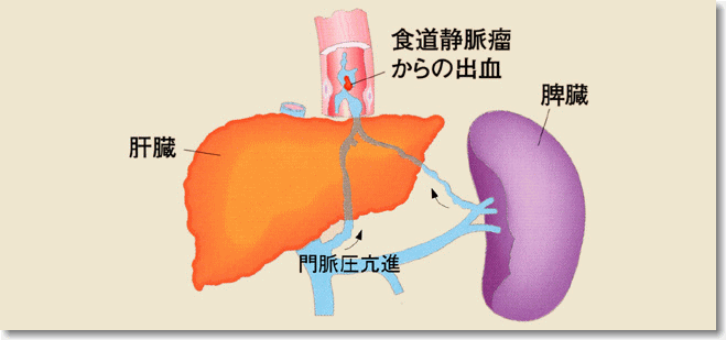 瘤 食道 静脈