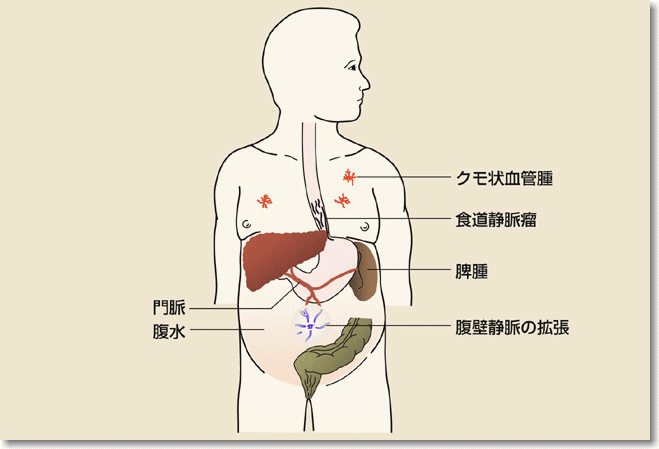 肝臓 腹水 余命